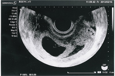 見え 7 ない 胎芽 週